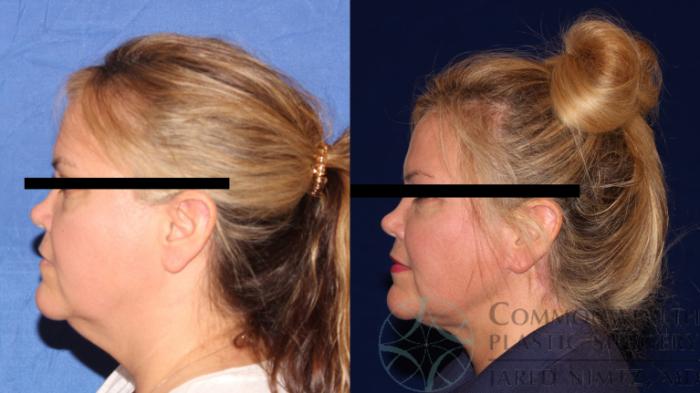 Before & After Neck Lift Case 117 Left Side View in Lexington & London, KY