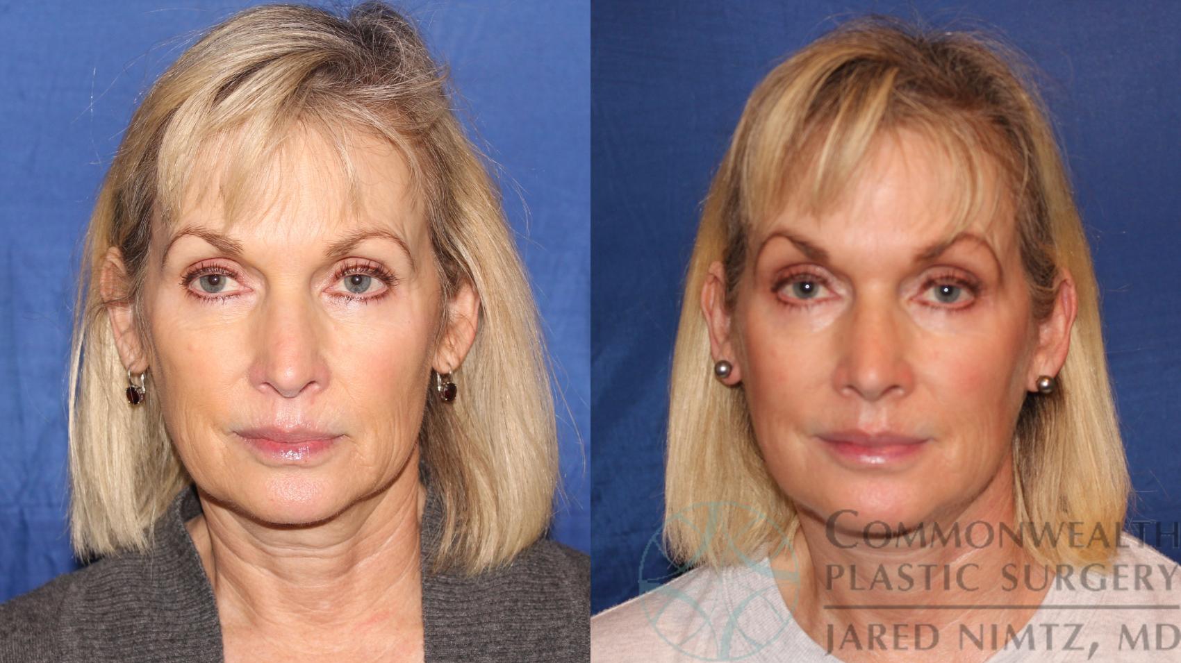 Before & After Neck Lift Case 118 Front View in Lexington & London, KY