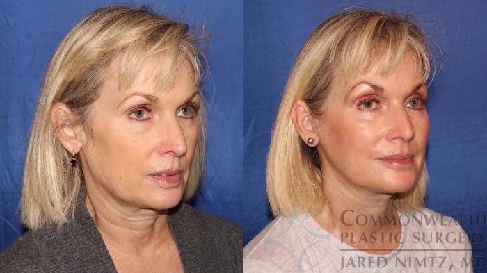 Before & After Neck Lift Case 118 Right Oblique View in Lexington & London, KY