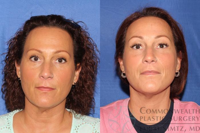 Before & After Neck Lift Case 126 Front View in Lexington & London, KY