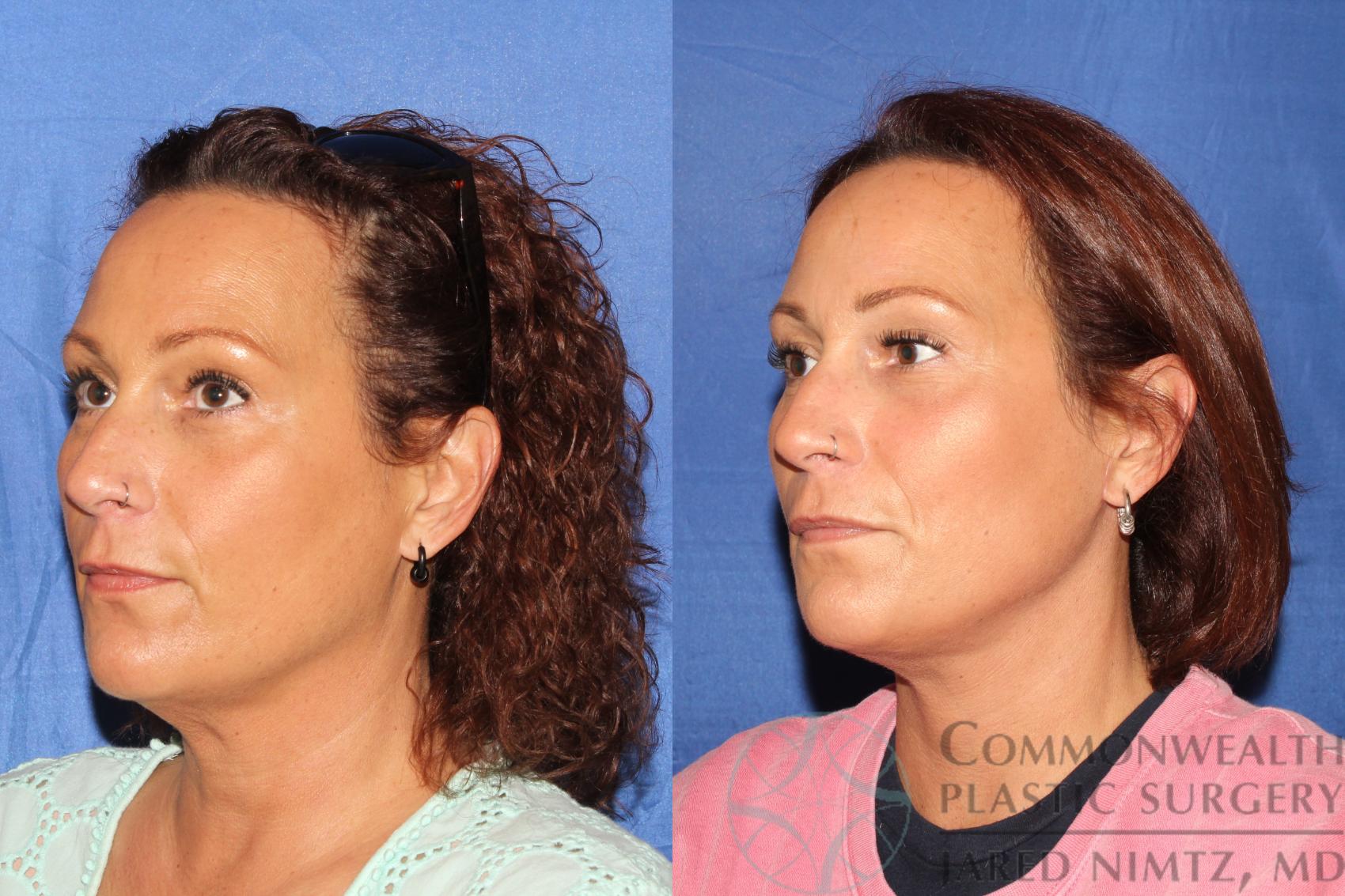 Before & After Neck Lift Case 126 Left Oblique View in Lexington & London, KY