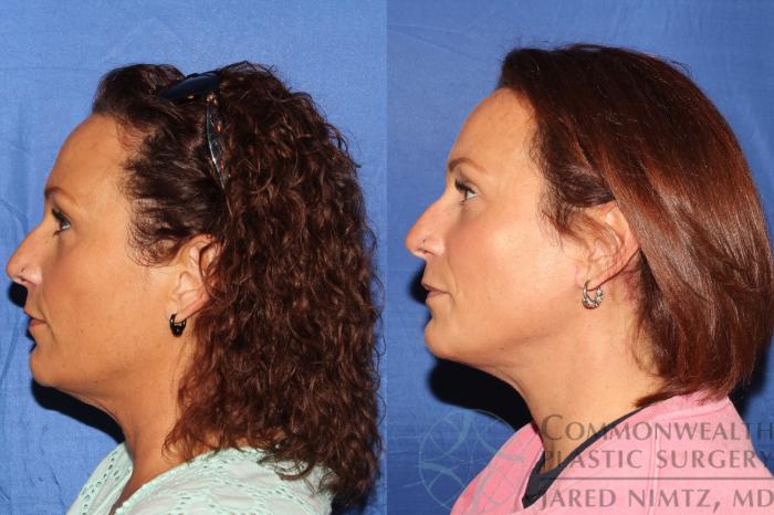 Before & After Neck Lift Case 126 Left Side View in Lexington & London, KY