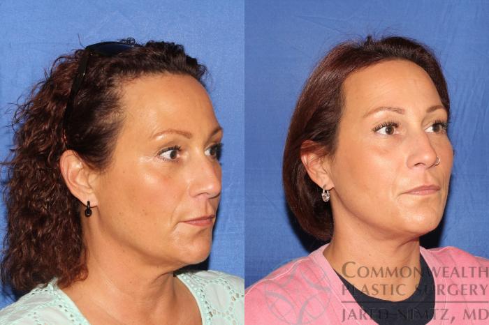 Before & After Neck Lift Case 126 Right Oblique View in Lexington & London, KY