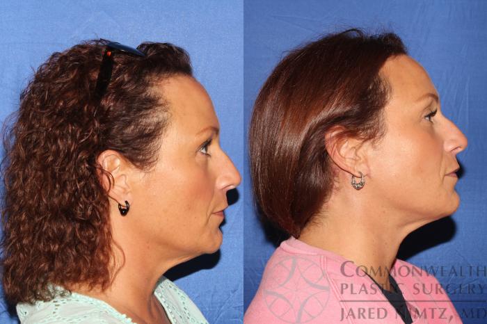 Before & After Neck Lift Case 126 Right Side View in Lexington & London, KY