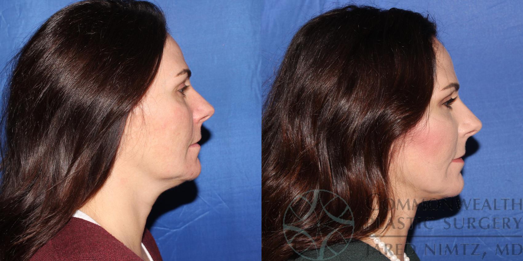 Before & After Neck Lift Case 89 View #2 View in Lexington & London, KY