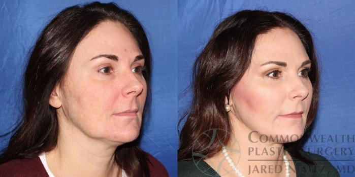 Before & After Neck Lift Case 89 View #3 View in Lexington & London, KY