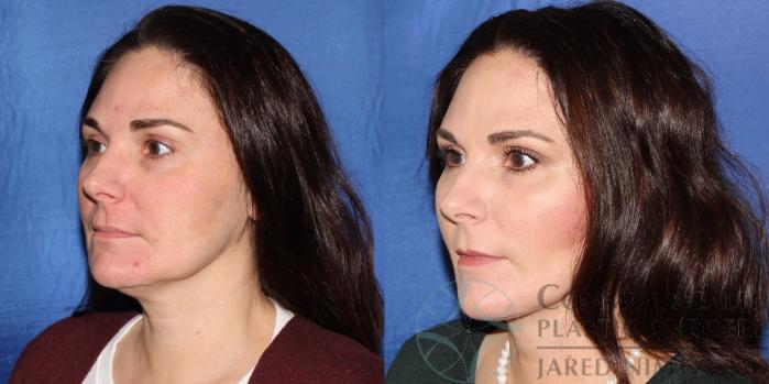 Before & After Neck Lift Case 89 View #4 View in Lexington & London, KY