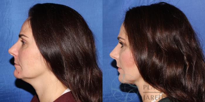 Before & After Neck Lift Case 89 View #5 View in Lexington & London, KY