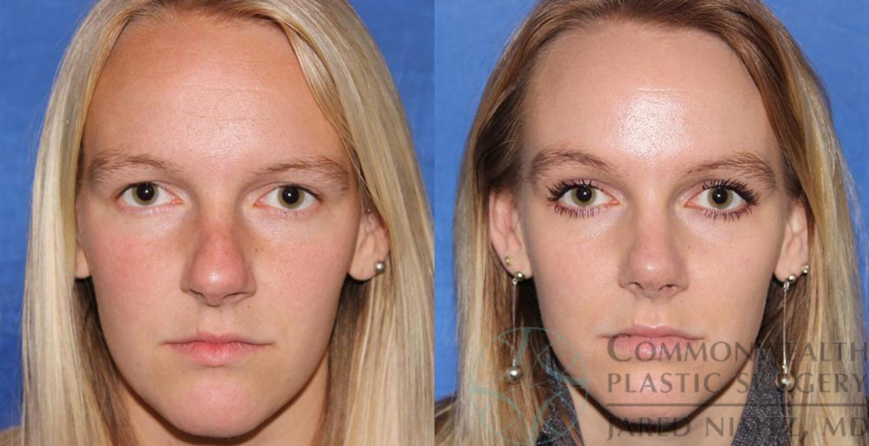 Before & After Rhinoplasty Case 57 View #1 View in Lexington & London, KY