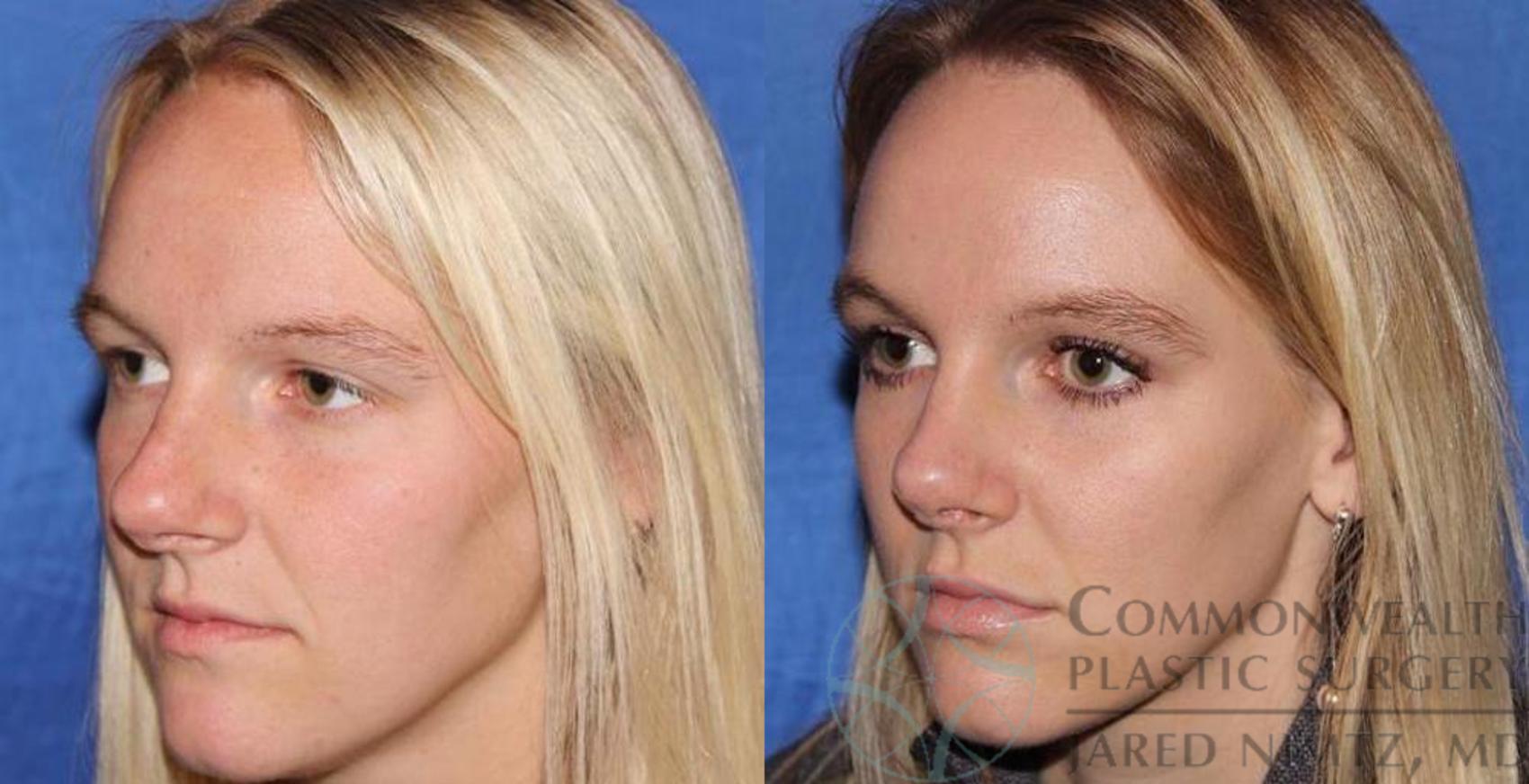 Before & After Rhinoplasty Case 57 View #2 View in Lexington & London, KY