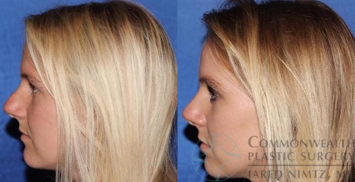 Before & After Rhinoplasty Case 57 View #3 View in Lexington & London, KY