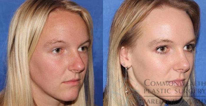 Before & After Rhinoplasty Case 57 View #4 View in Lexington & London, KY