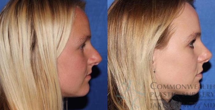 Before & After Rhinoplasty Case 57 View #5 View in Lexington & London, KY