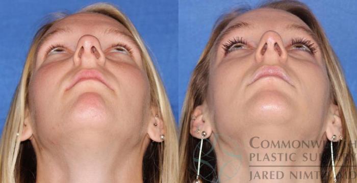 Before & After Rhinoplasty Case 57 View #6 View in Lexington & London, KY