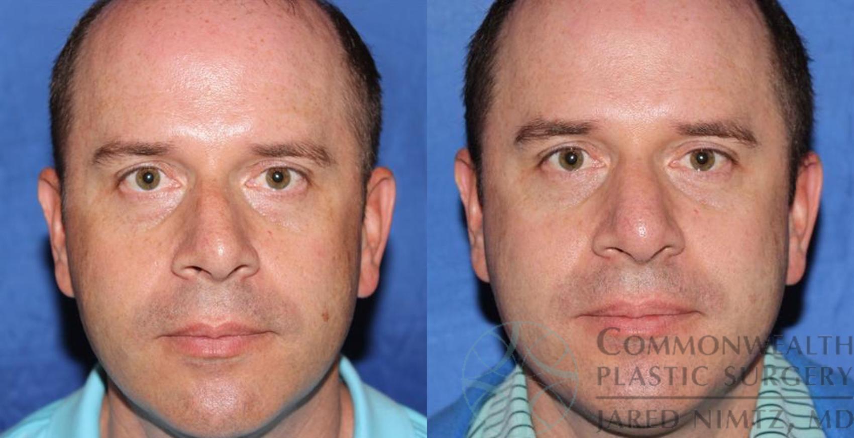 Rhinoplasty Case 58 Before & After View #1 | Lexington & London, KY | Commonwealth Plastic Surgery