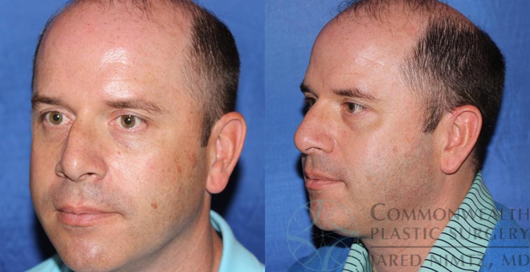 Before & After Rhinoplasty Case 58 View #2 View in Lexington & London, KY