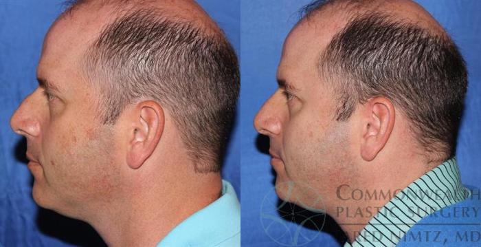 Before & After Rhinoplasty Case 58 View #3 View in Lexington & London, KY