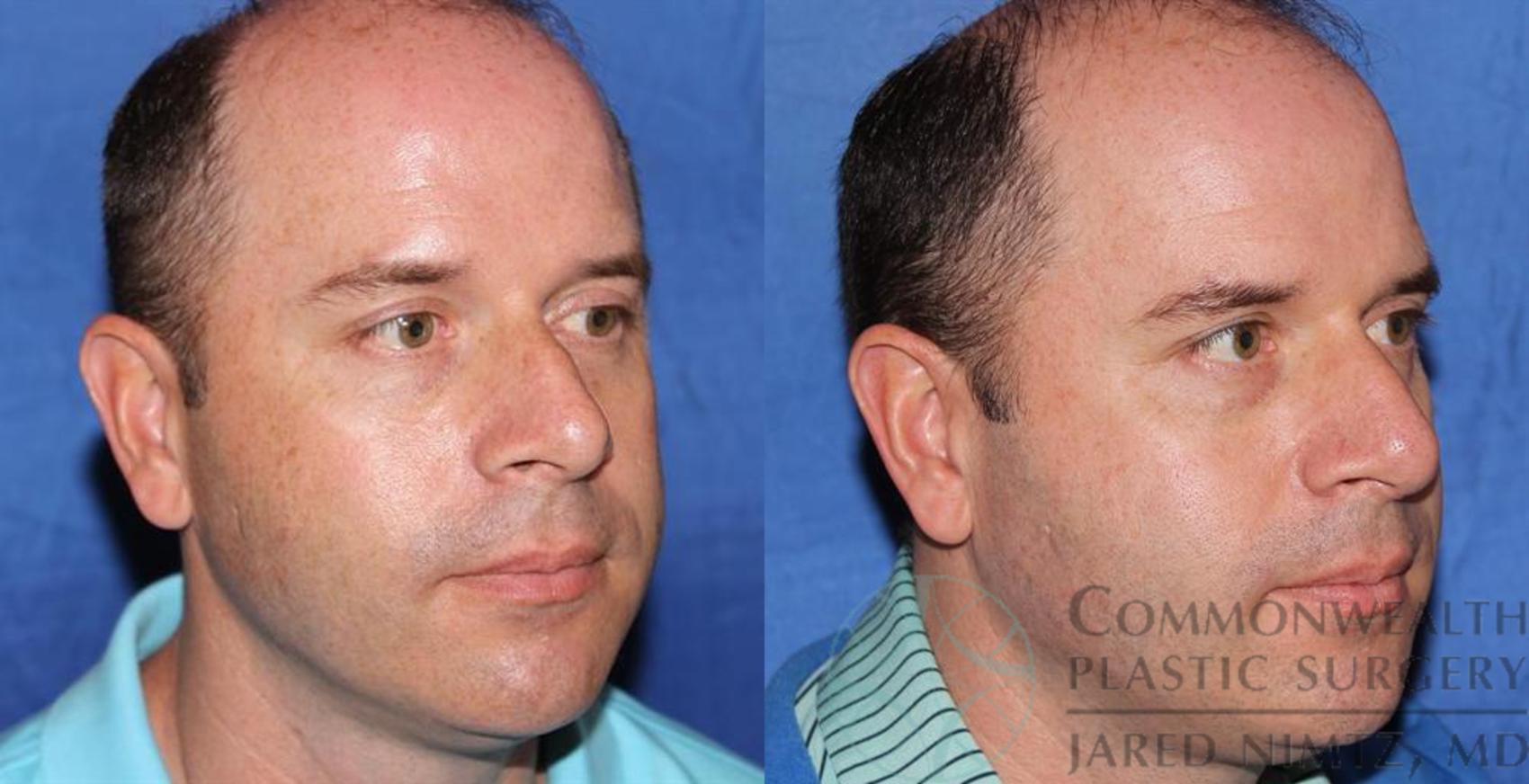 Before & After Rhinoplasty Case 58 View #4 View in Lexington & London, KY