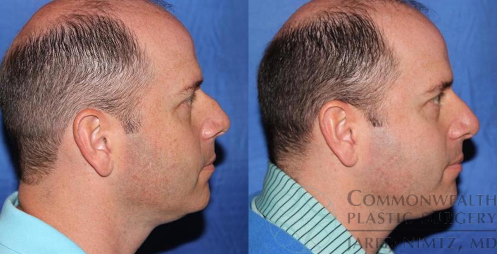 Before & After Rhinoplasty Case 58 View #5 View in Lexington & London, KY