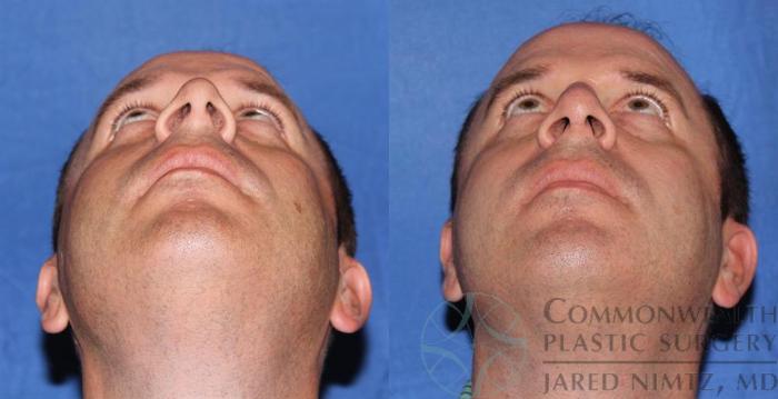 Before & After Rhinoplasty Case 58 View #6 View in Lexington & London, KY