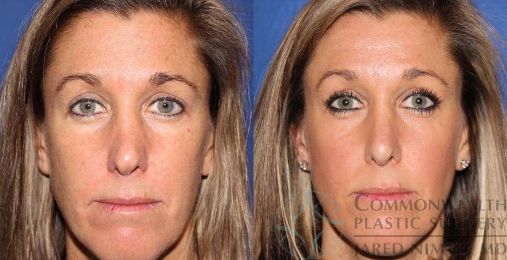 Before & After Rhinoplasty Case 59 View #1 View in Lexington & London, KY