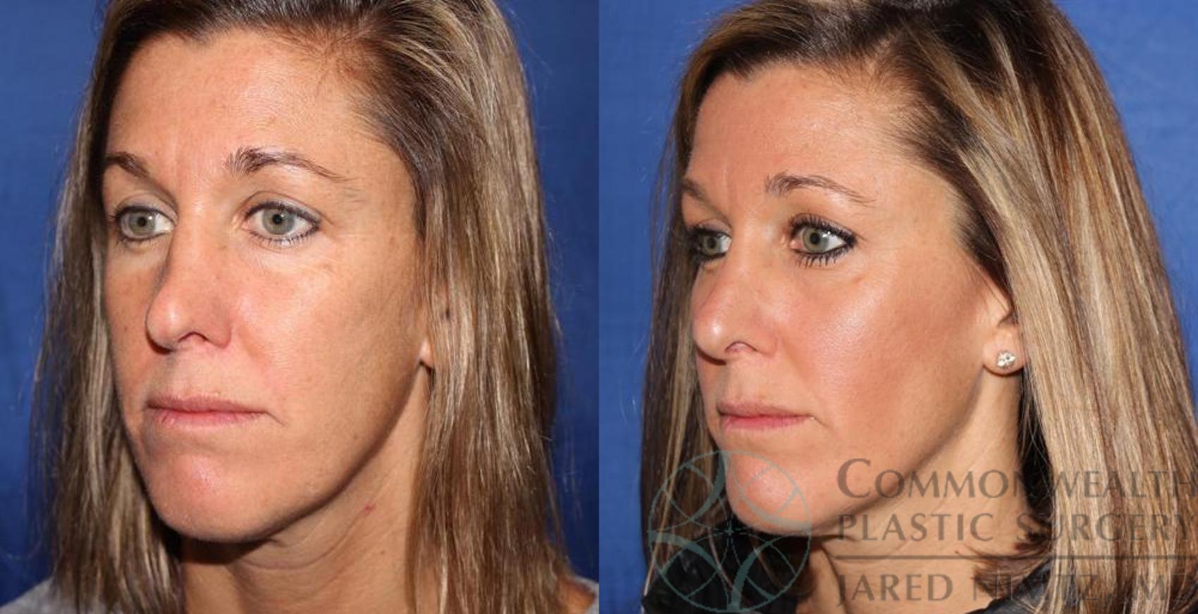 Before & After Rhinoplasty Case 59 View #2 View in Lexington & London, KY
