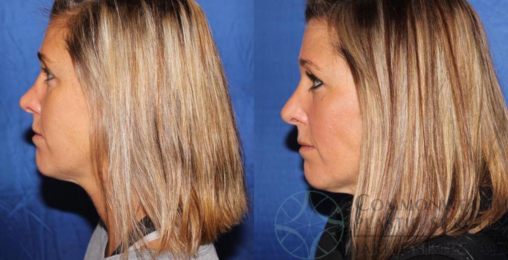Before & After Rhinoplasty Case 59 View #3 View in Lexington & London, KY