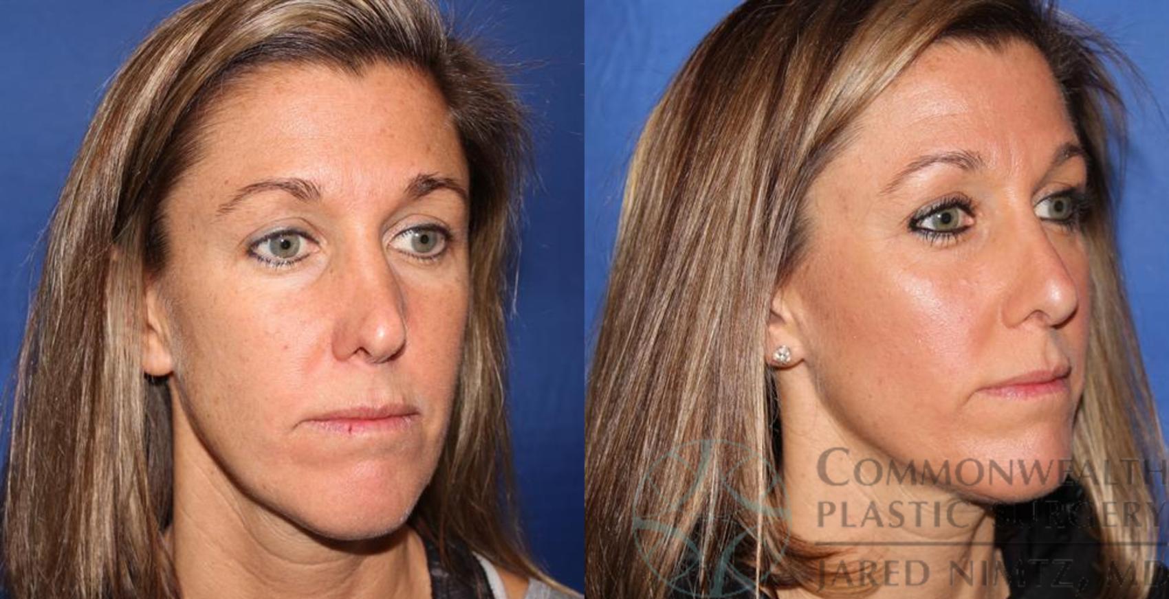 Before & After Rhinoplasty Case 59 View #4 View in Lexington & London, KY