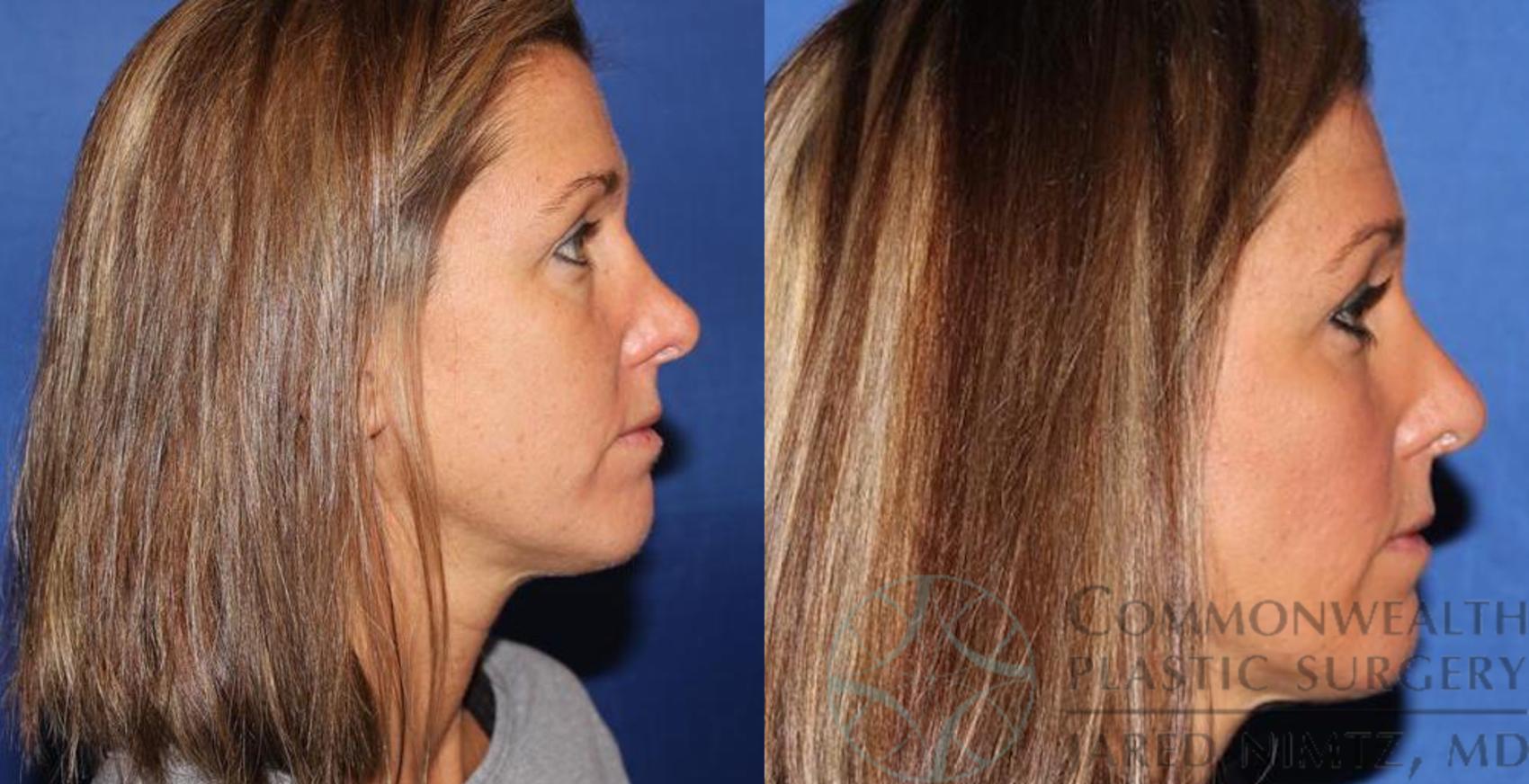 Before & After Rhinoplasty Case 59 View #5 View in Lexington & London, KY