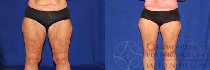 Before & After Thigh Lift Case 98 Front View in Lexington & London, KY