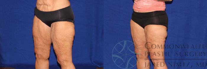Before & After Thigh Lift Case 98 Left Oblique View in Lexington & London, KY