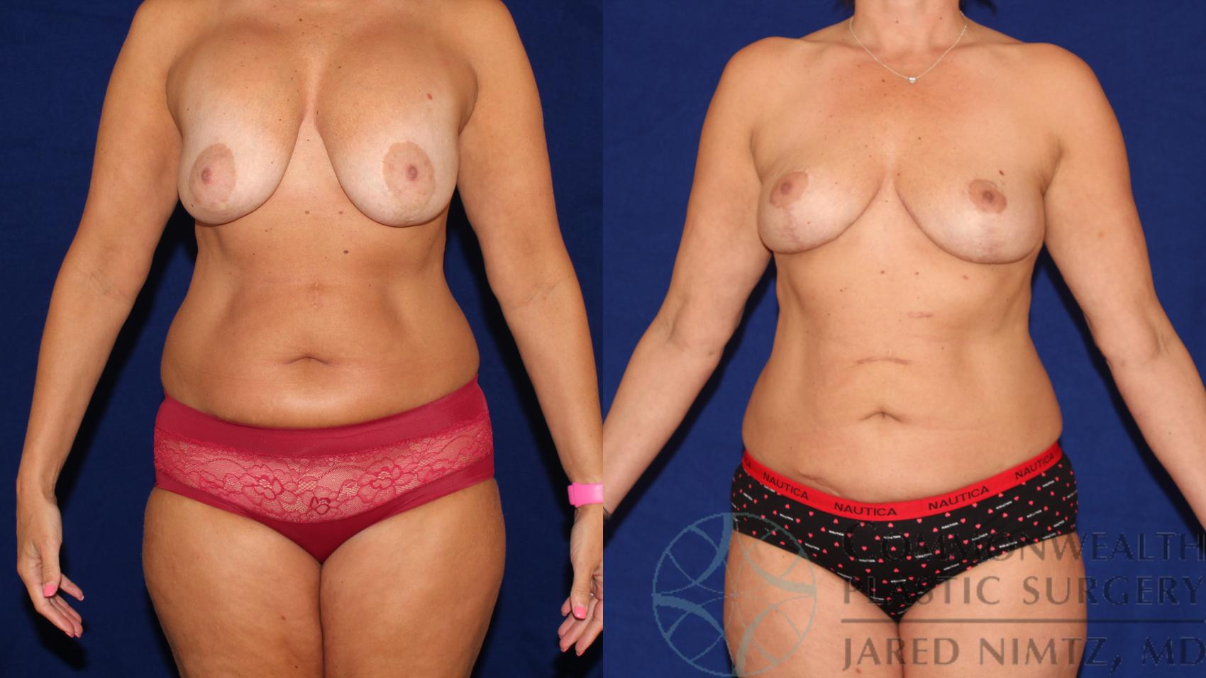 Before & After Tummy Tuck Case 112 Front View in Lexington & London, KY