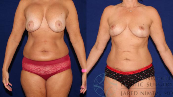 Before & After Breast Lift Case 112 Front View in Lexington & London, KY