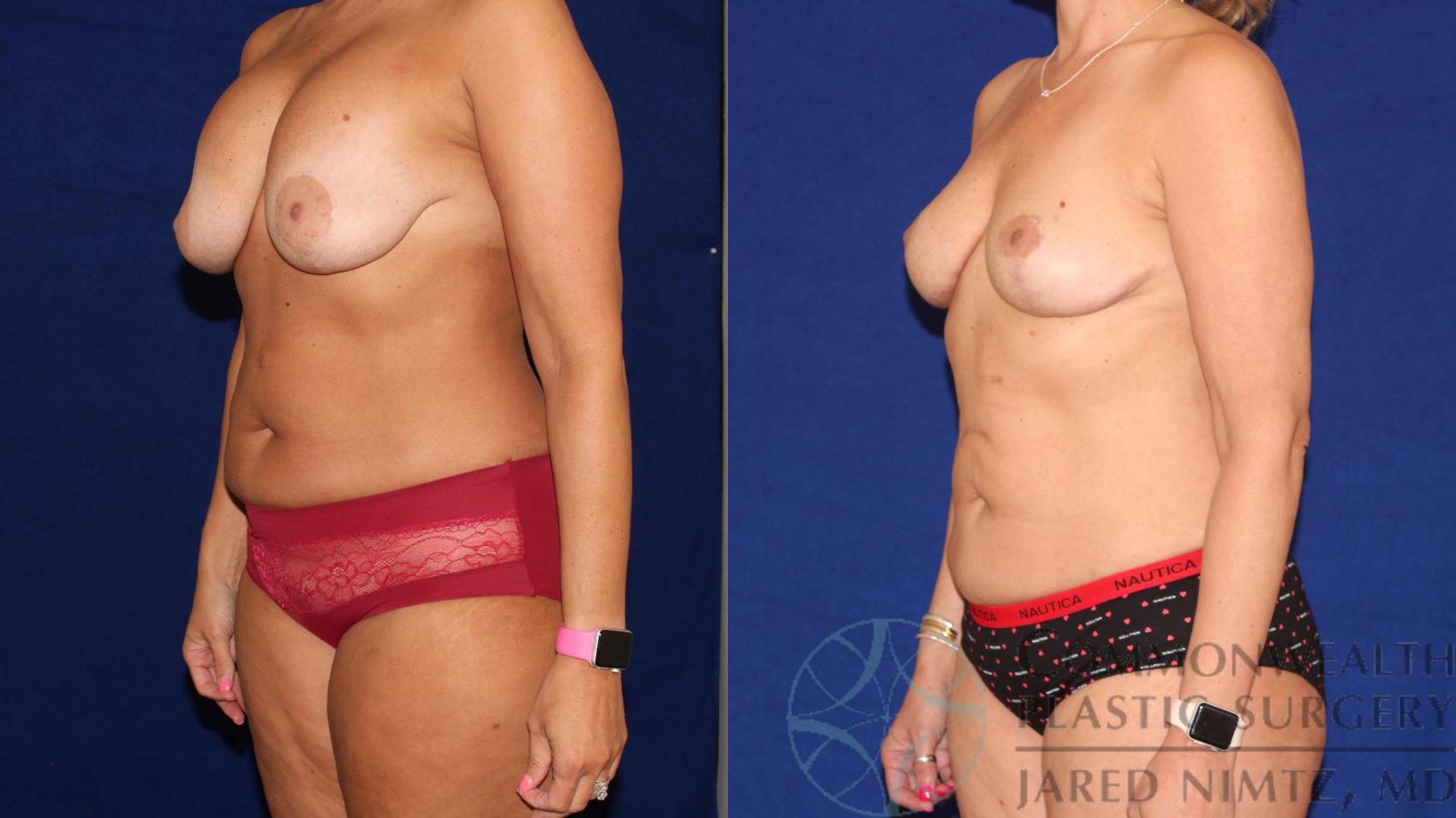Before & After Tummy Tuck Case 112 Left Oblique View in Lexington & Lousiville, KY