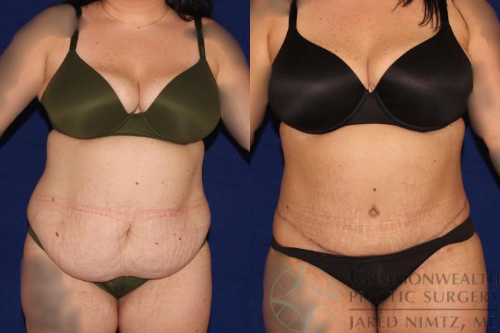 Before & After Tummy Tuck Case 122 Front View in Lexington & London, KY