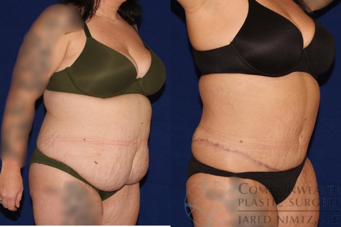 Before & After Tummy Tuck Case 122 Left Oblique View in Lexington & London, KY