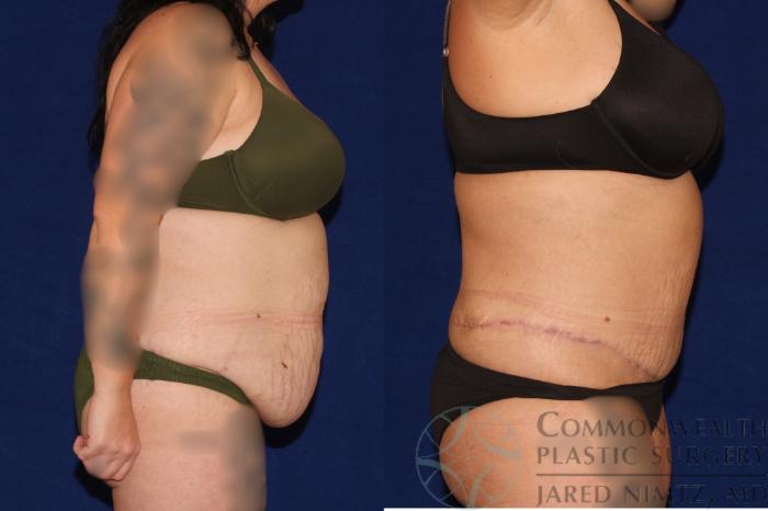 Before & After Tummy Tuck Case 122 Left Side View in Lexington & London, KY