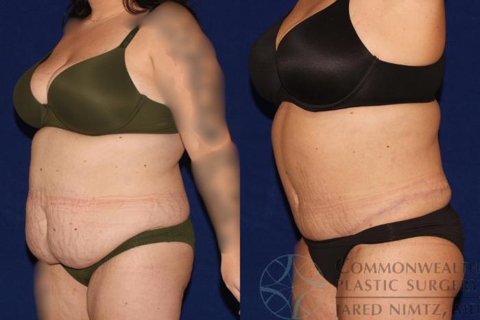 Before & After Tummy Tuck Case 122 Right Oblique View in Lexington & London, KY