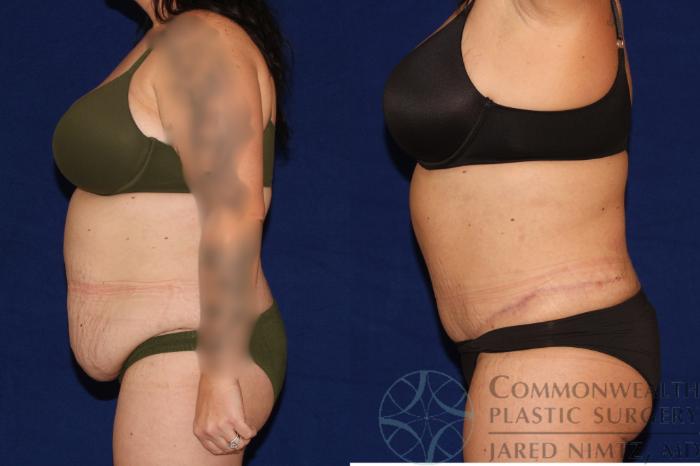 Before & After Tummy Tuck Case 122 Right Side View in Lexington & London, KY