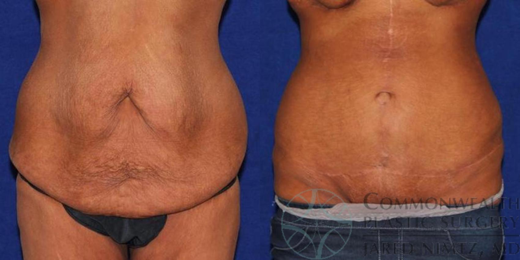 Before & After Tummy Tuck Case 36 View #1 View in Lexington & London, KY