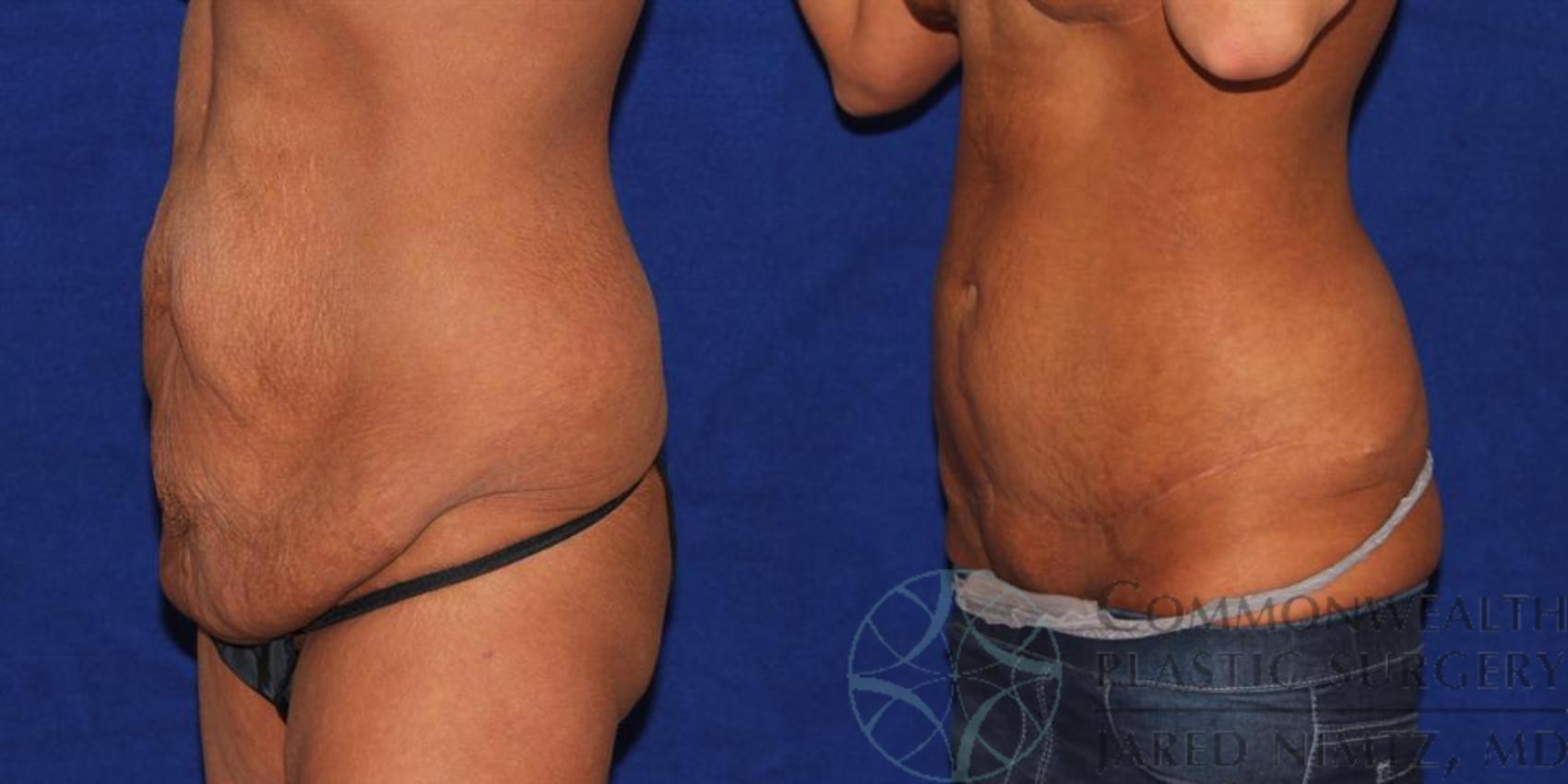Before & After Tummy Tuck Case 36 View #2 View in Lexington & London, KY