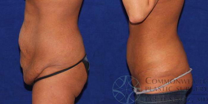 Before & After Tummy Tuck Case 36 View #3 View in Lexington & London, KY