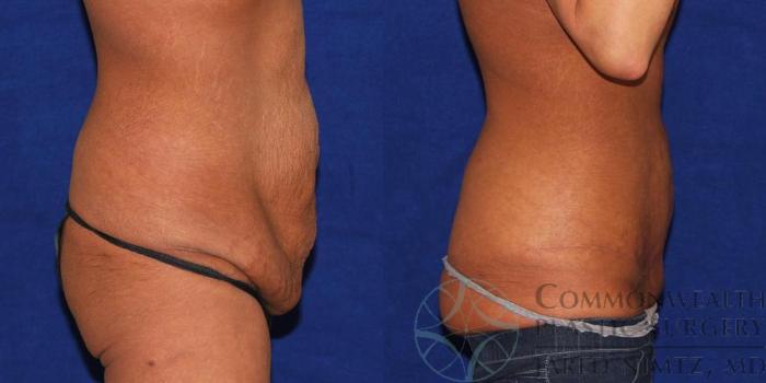 Before & After Post Weight Loss Contouring Case 36 View #4 View in Lexington & London, KY
