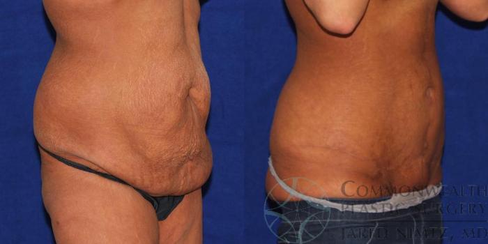Before & After Tummy Tuck Case 36 View #5 View in Lexington & London, KY
