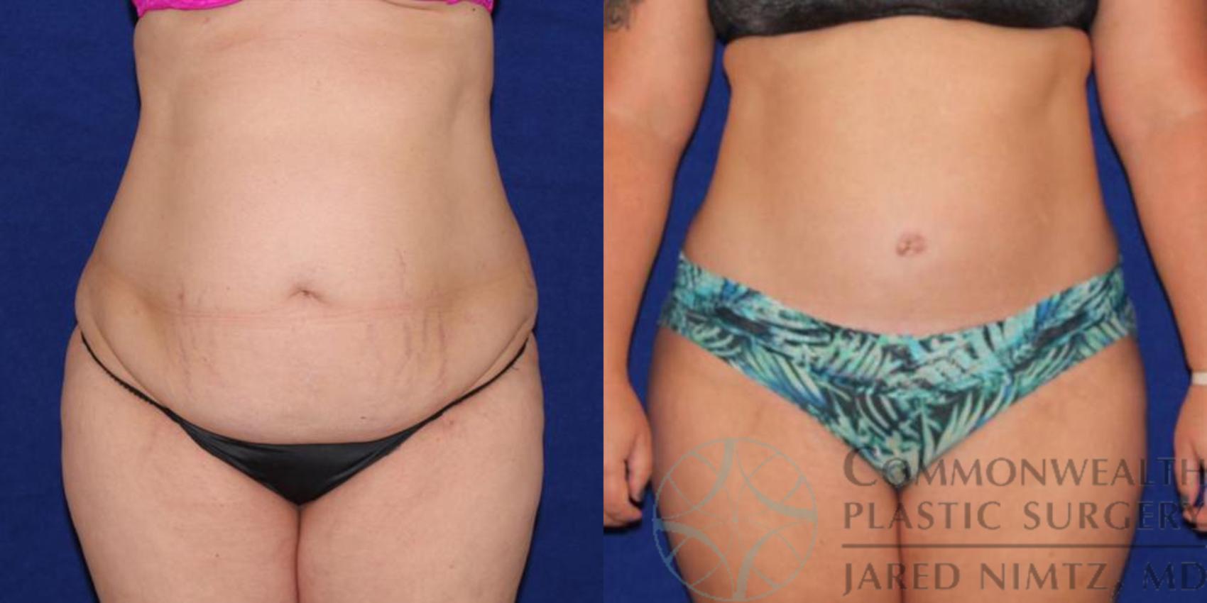 Before & After Tummy Tuck Case 37 View #1 View in Lexington & London, KY