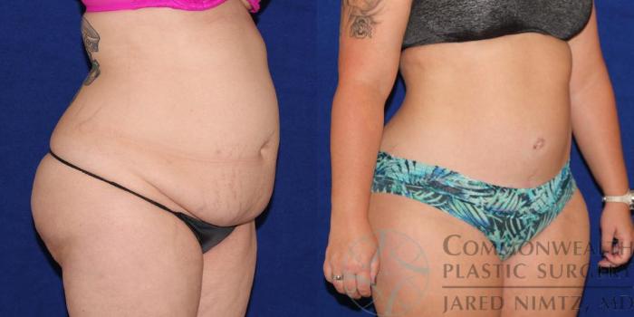 Before & After Tummy Tuck Case 37 View #2 View in Lexington & London, KY