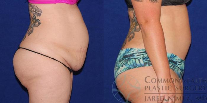 Before & After Tummy Tuck Case 37 View #3 View in Lexington & London, KY