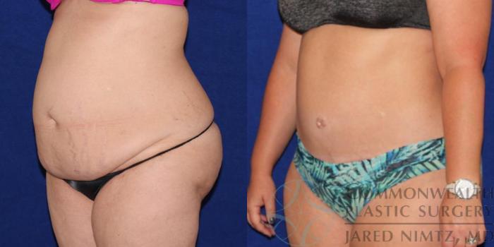Before & After Tummy Tuck Case 37 View #4 View in Lexington & London, KY