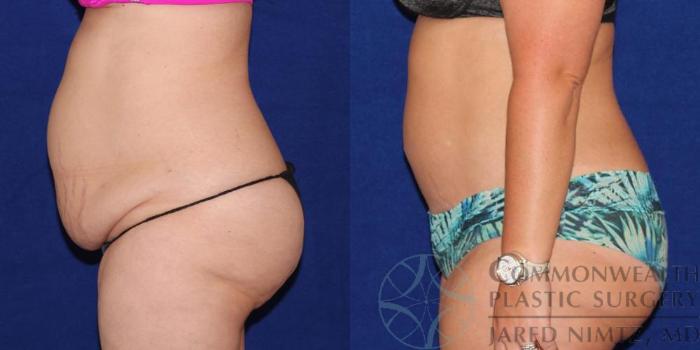 Before & After Tummy Tuck Case 37 View #5 View in Lexington & London, KY
