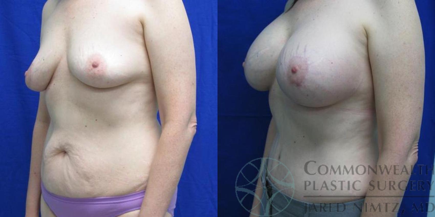 Before & After Tummy Tuck Case 38 View #2 View in Lexington & London, KY